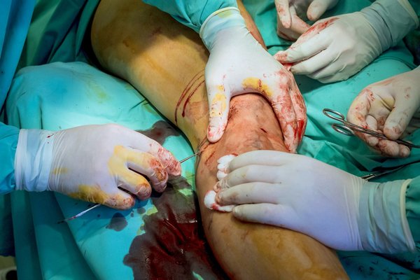 Chirurgie orthopédique : experts à votre service en provence